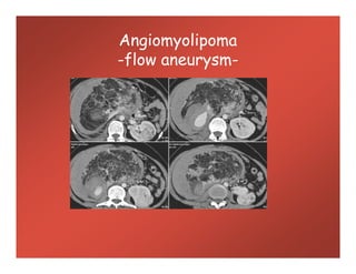 Angiomyolipoma
-flow aneurysm-
 