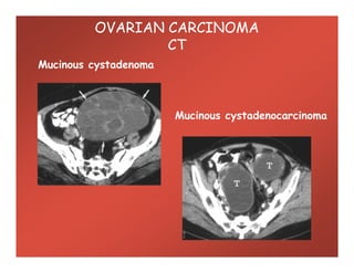 Mucinous cystadenoma
Mucinous cystadenocarcinoma
OVARIAN CARCINOMA
CT
 