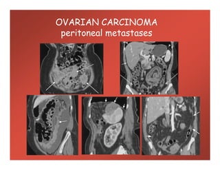 OVARIAN CARCINOMA
peritoneal metastases
 