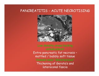 PANCREATITIS - ACUTE NECROTISING
Low density areas lacking
enhancement
Extra-pancreatic fat necrosis –
mottled / bubbly soft tissue
Vessels seen “skeletonized”
Thickening of Gerota’s and
lateroconal fascia
 