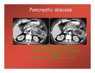 Pancreatic abscess
Air within necrosis / collection
Remember fistula – check contiguous
bowel
Fever, raised WBC count, toxic
 