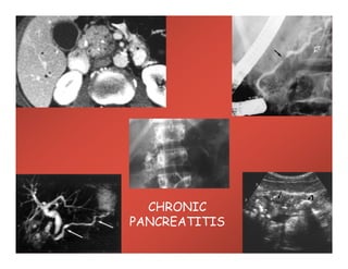 CHRONIC
PANCREATITIS
 