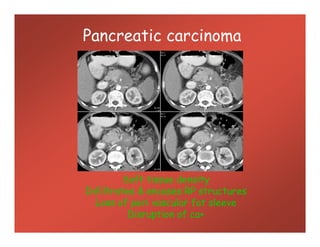 Pancreatic carcinoma
Soft tissue density
Infiltrates & encases RP structures
Loss of peri vascular fat sleeve
Disruption of ca+
 