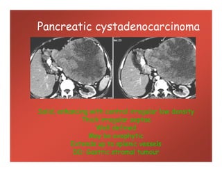 Pancreatic cystadenocarcinoma
Solid, enhancing with central irregular low density
Thick irregular septae
Well defined
May be exophytic
Extends up to splenic vessels
DD: Gastric stromal tumour
 