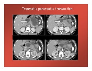 Traumatic pancreatic transection
 