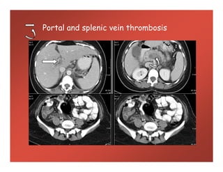 Portal and splenic vein thrombosis
 