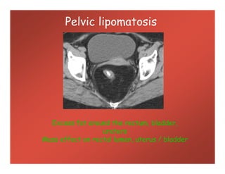 Pelvic lipomatosis
Excess fat around the rectum, bladder,
ureters
Mass effect on rectal lumen, uterus / bladder
 