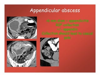 Appendicular abscess
>6 mm diam = appendicitis
RIF collection
+/- appendix
Collection should lead to caecal
pole
>6 mm diam = appendicitis
RIF collection
+/- appendix
Collection should lead to caecal
pole
 