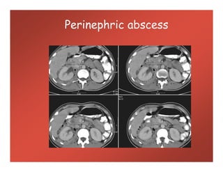 Perinephric abscess
 