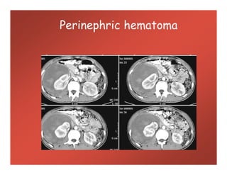Perinephric hematoma
 