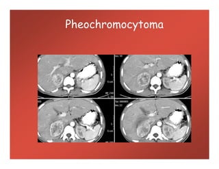 Pheochromocytoma
 