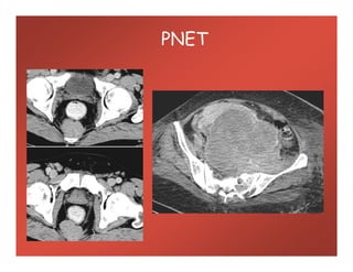 PNET
 