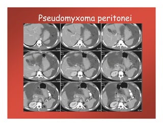 Pseudomyxoma peritonei
 