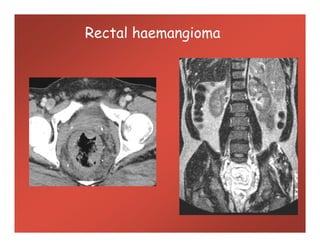 Rectal haemangioma
 