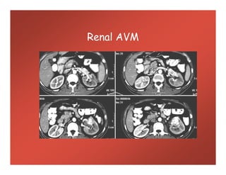 Renal AVM
 