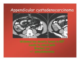 Appendicular cystadenocarcinoma
Widened low density lumen in RIF
Leads to caecal pole
Bracket ca+
+/- pseudomyxoma
 