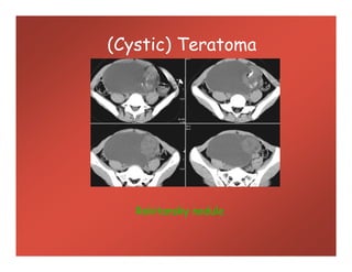 (Cystic) Teratoma
Rokitansky nodule
 