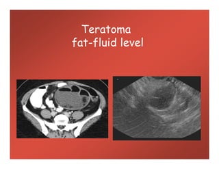 Teratoma
fat-fluid level
 