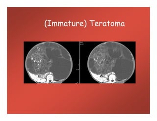 (Immature) Teratoma
 