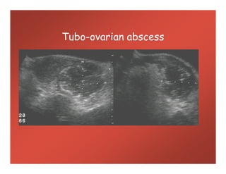 Tubo-ovarian abscess
 