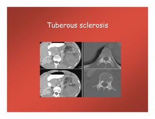 Tuberous sclerosis
 