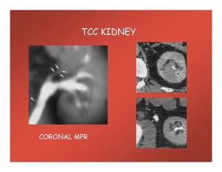 TCC KIDNEY
CORONAL MPR
 
