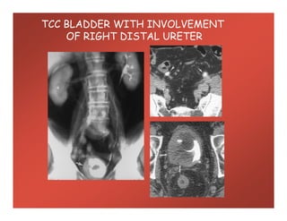 TCC BLADDER WITH INVOLVEMENT
OF RIGHT DISTAL URETER
 