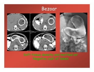 Bezoar
Soft tissue density and mottled air
Negative cast of lumen
 