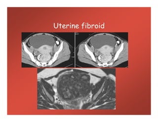 Uterine fibroid
 