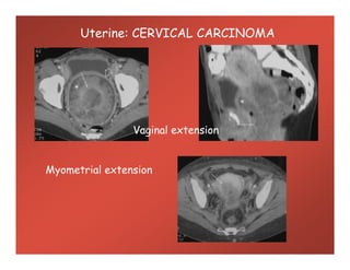 Uterine: CERVICAL CARCINOMA
Vaginal extensionVaginal extension
Myometrial extension
 