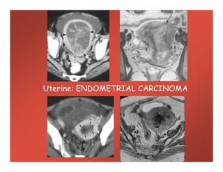 Uterine: ENDOMETRIAL CARCINOMAUterine: ENDOMETRIAL CARCINOMA
 