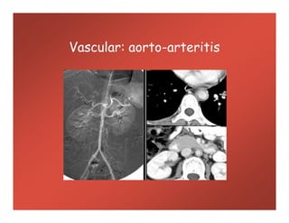 Vascular: aorto-arteritis
 