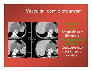 Vascular: aortic aneurysm
*Contrast =
aorta
*Unopacified =
thrombus
*Perianeurysmal
fibrosis
*Subacute leak
– soft tissue
density
*Contrast =
aorta
*Unopacified =
thrombus
*Perianeurysmal
fibrosis
*Subacute leak
– soft tissue
density
 
