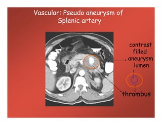 Vascular: Pseudo aneurysm of
Splenic artery
contrast
filled
aneurysm
lumen
contrast
filled
aneurysm
lumen
thrombus
 