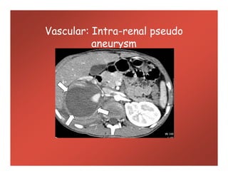 Vascular: Intra-renal pseudo
aneurysm
 
