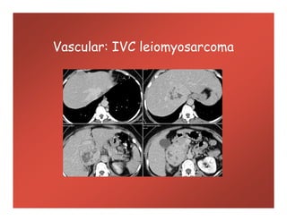 Vascular: IVC leiomyosarcoma
 