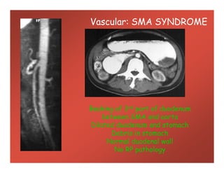 Vascular: SMA SYNDROME
Beaking of 3rd part of duodenum
between SMA and aorta
Dilated duodenum and stomach
Debris in stomach
Normal duodenal wall
No RP pathology
 