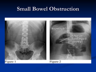 Small Bowel Obstruction 