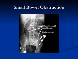 Small Bowel Obstruction 