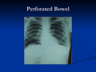 Perforated Bowel 