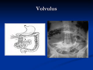 Volvulus 