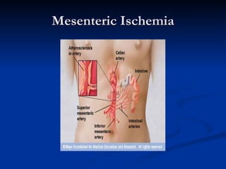 Mesenteric Ischemia 