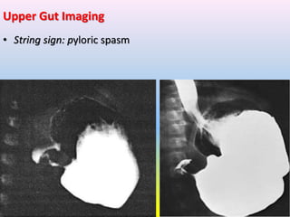 Abdominal pain | PPTX