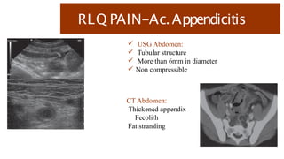 RLQ PAIN-Ac.Appendicitis
 USG Abdomen:
 Tubular structure
 More than 6mm in diameter
 Non compressible
CT Abdomen:
Thickened appendix
Fecolith
Fat stranding
 