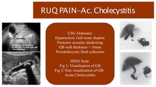 RUQ PAIN-Ac. Cholecystitis
USG Abdomen:
Hyperechoic Gall stone shadow
Posterior acoustic shadowing
GB wall thickness > 3mms
Pericholecystic fluid collection
HIDA Scan:
Fig 1: Visualisation of GB
Fig 2: Non visualization of GB-
Acute Cholecystitis
 