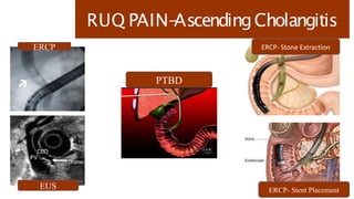 RUQ PAIN-
AscendingCholangitis
PTBD
ERCP
EUS
ERCP- Stone Extraction
ERCP- Stent Placement
 