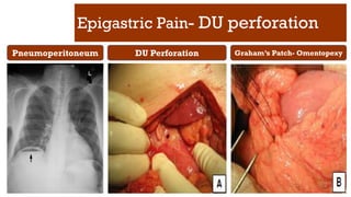 Epigastric Pain- DU perforation
Pneumoperitoneum DU Perforation Graham’s Patch- Omentopexy
 