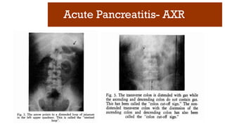 Acute Pancreatitis- AXR
 