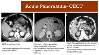 Acute Pancreatitis- CECT
CECT: Acute Pancreatitis
Diffusely enlarged pancreas with low
density from edema
Phlegmon / Inflammatory Mass
White arrowheads: Phlegmon
Black arrowhead: Pancreatic calcification
Large Arrow: Peripancreatic fascial
infiltration
Acute Pancreatitis / Pancreatic Necrosis
Arrow: No enhancement of pancreas
with IV contrast
Arrowheads: Normal enhancement in
the tail of Pancreas.
 
