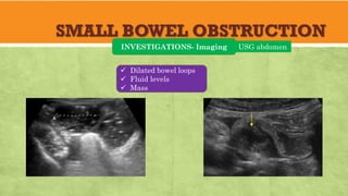SMALL BOWEL OBSTRUCTION
INVESTIGATIONS- Imaging USG abdomen
✓ Dilated bowel loops
✓ Fluid levels
✓ Mass
 